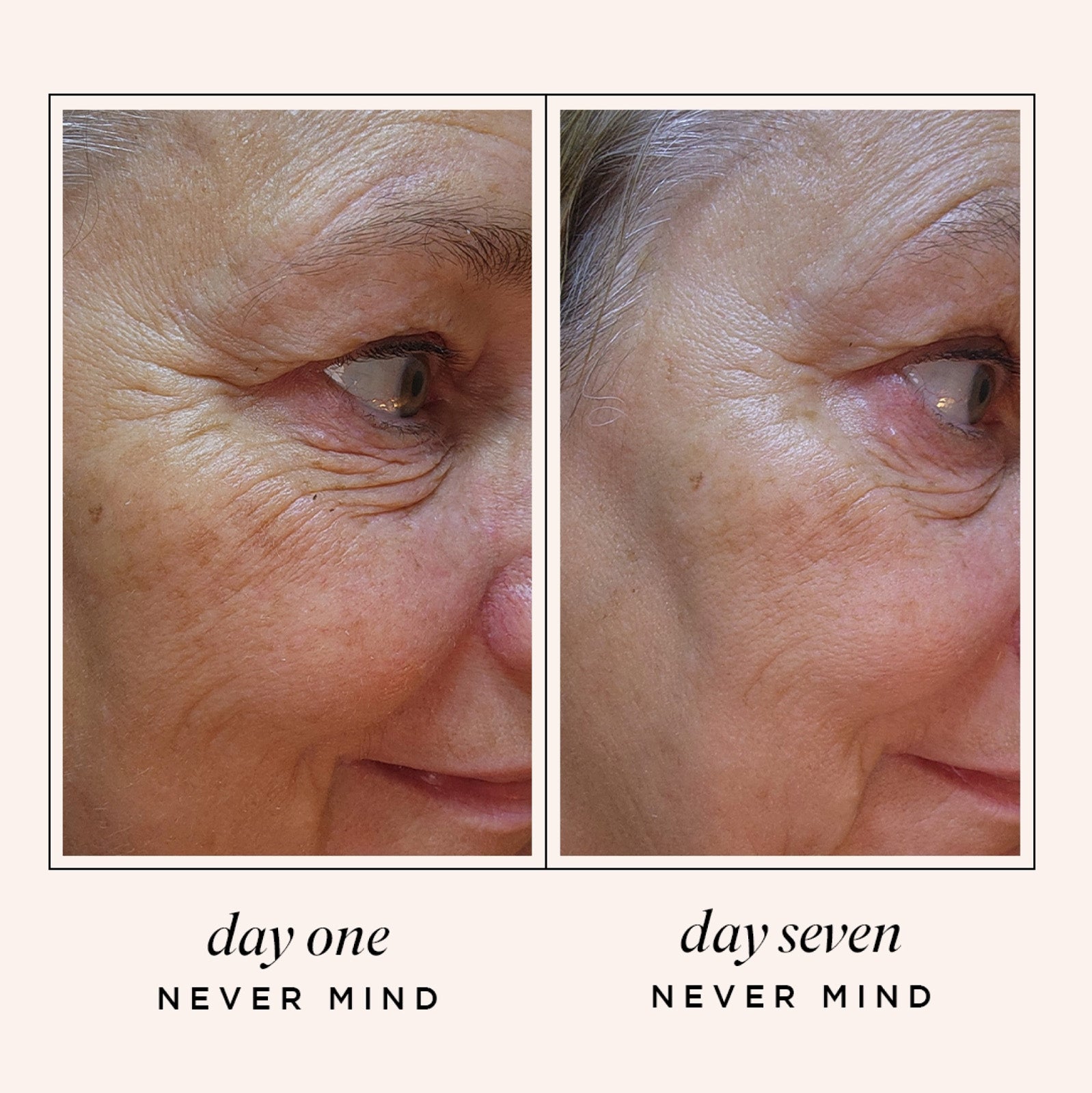 Never Mind No-Needles Fine Lines and Wrinkles Treatment