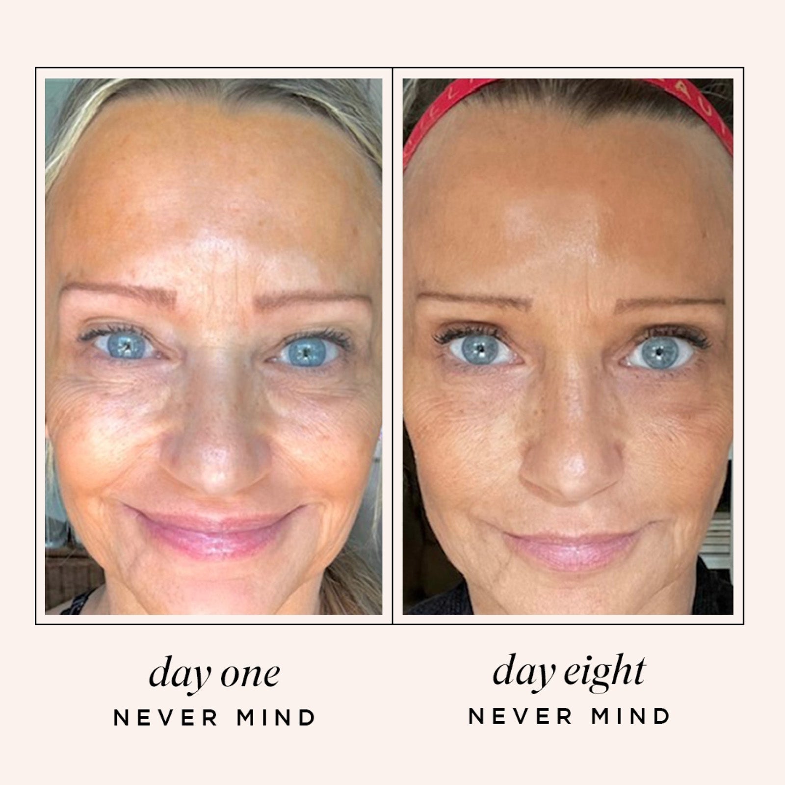Never Mind No-Needles Fine Lines and Wrinkles Treatment